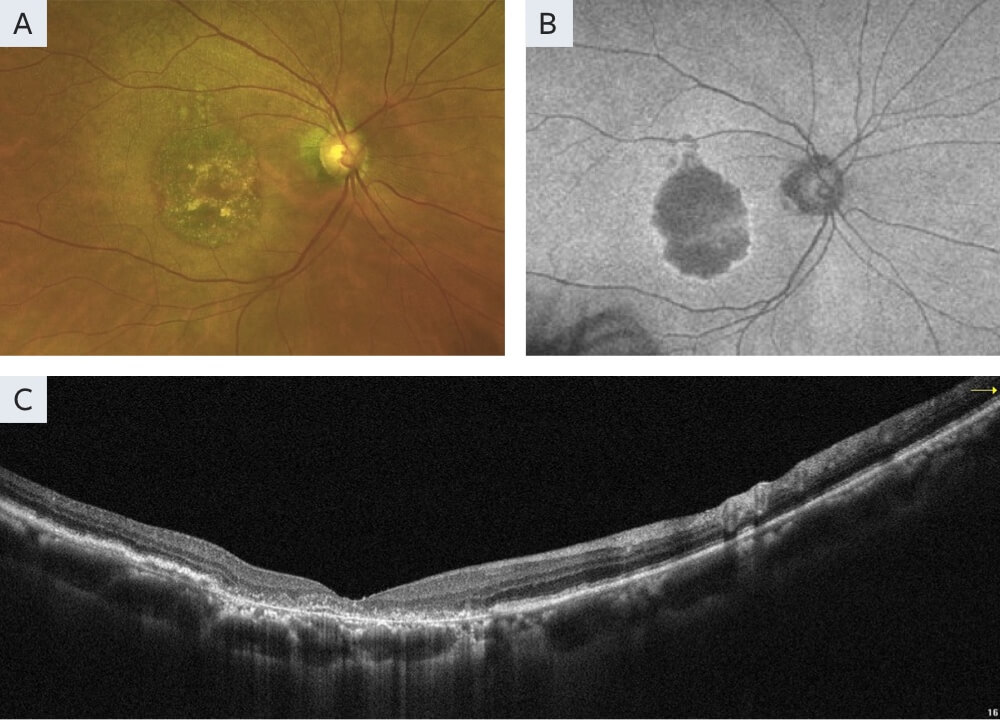 GA Case Compendium: Multimodal Imaging for Following Geographic Atrophy ...